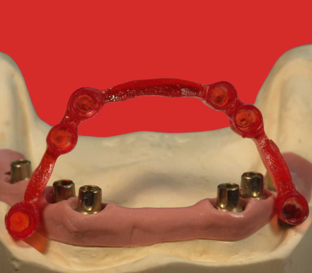 Implantat techni primopattern primotec